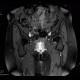Barium, beam hardening artifacts: MRI - Magnetic Resonance Imaging